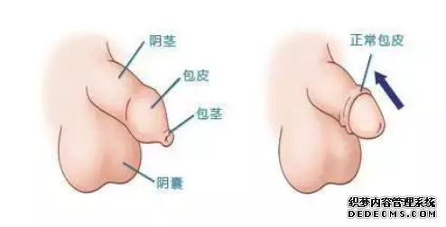 马鞍山当涂县我们怎么确定自己包皮是否过长?