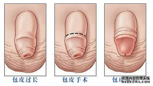 马鞍山谁知道怎样才算包皮过长?有什么危害?